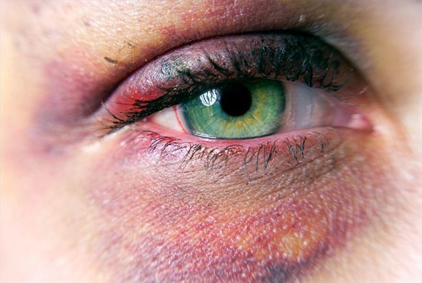 article-new-thumbnail_ehow_images_a02_2l_f3_treat-black-eye-bruise-800x800
